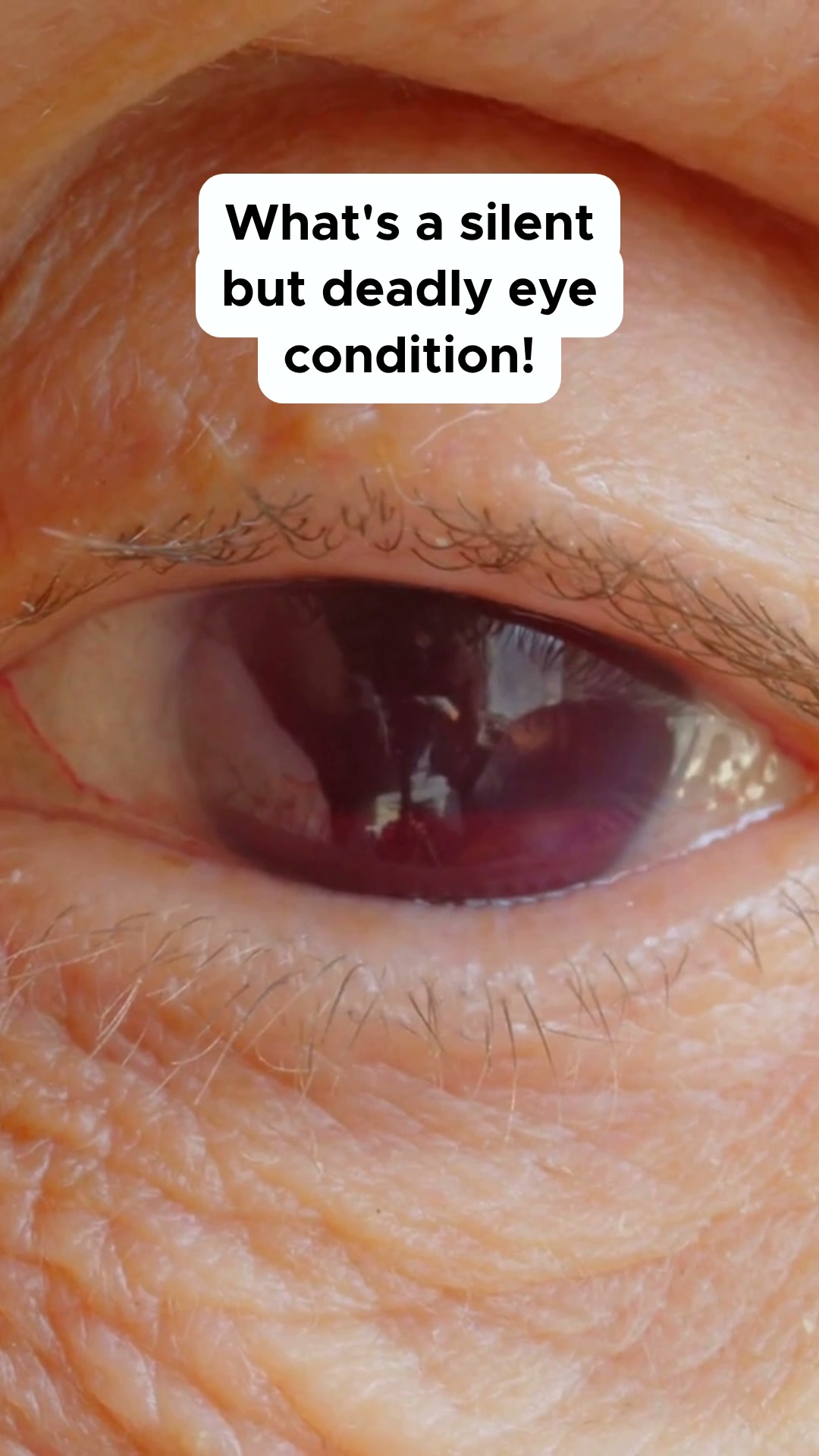 The glaucoma catch